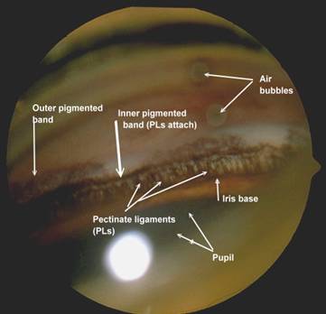 AOC-Eye-Info_Glaucoma002